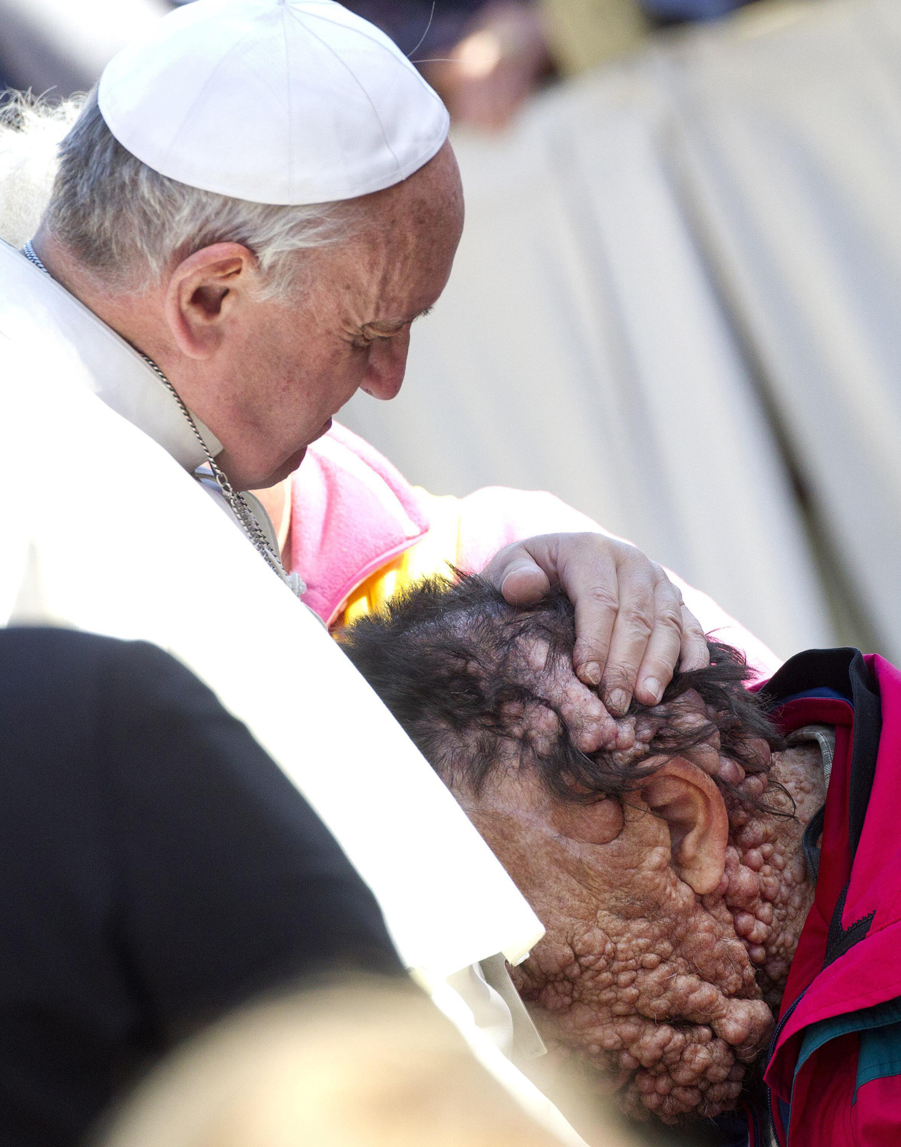 Pope embraces man disfigured by neurofibromatosis
